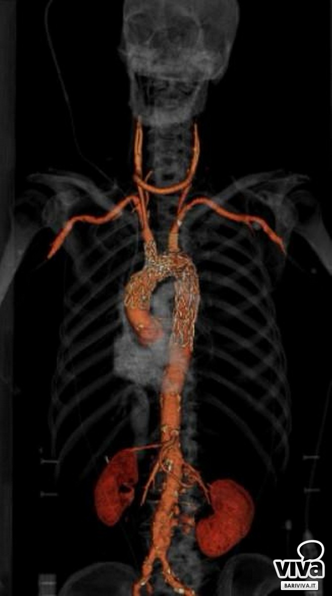 Immagine 3D dell'arco aortico dopo la sostituzione