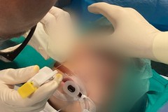 Policlinico di Bari, radiologia mini-invasiva pediatrica per evitare interventi chirurgici
