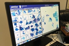 Tumore collo dell’utero, con l’IA qualità e velocità di diagnosi: da ASL Bari diagnostica citologica digitale