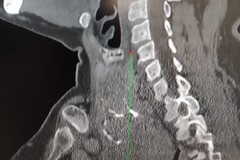 Gozzo esteso nel torace, operata con successo una paziente di 65 anni al Policlinico di Bari