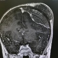 Bari, 14 ore di intervento per rimuovere tumore al cranio da un paziente di sette anni