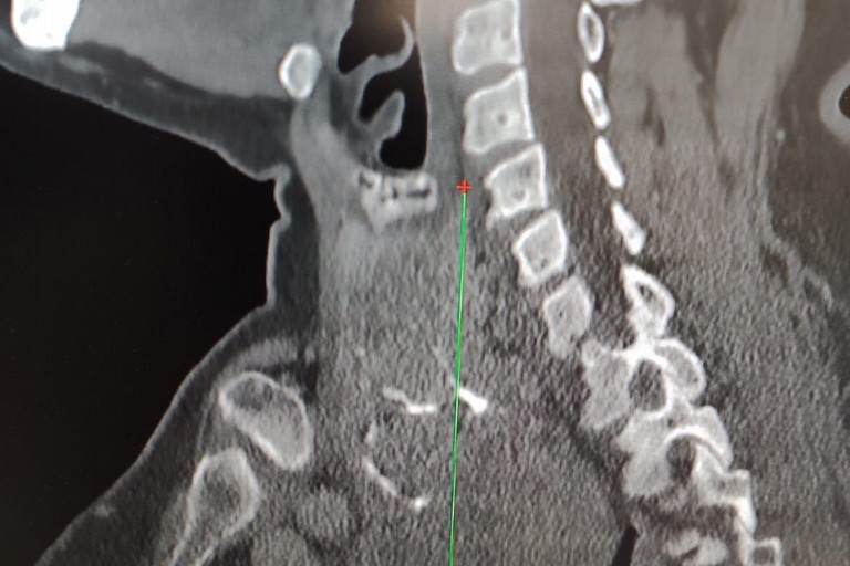 Il gozzo operato al Policlinico di Bari