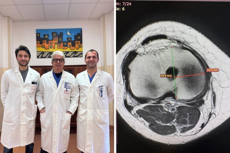 Trapianto meniscale da donatore
