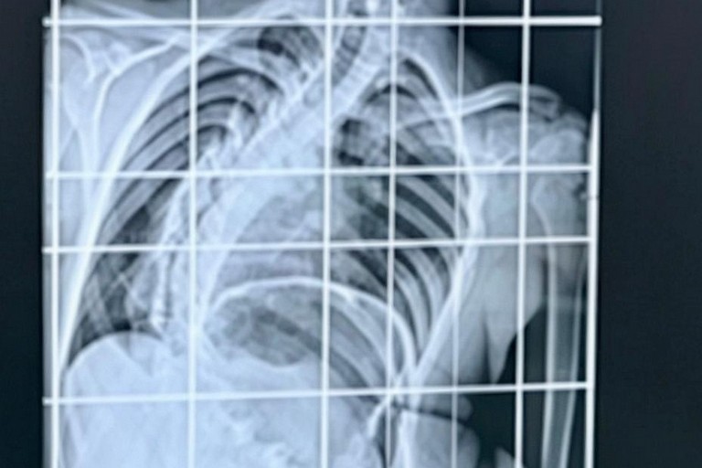 Radiografia prima dell'intervento. <span>Foto Policlinico di Bari </span>